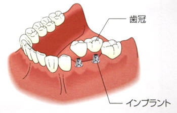 インプラント