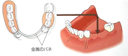 入れ歯