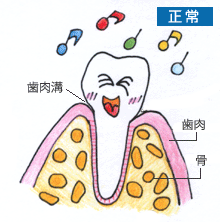 歯周病の進行状況